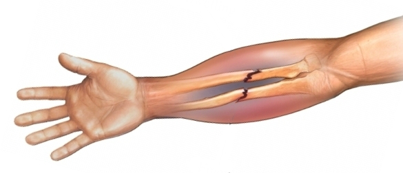 Переломы костей предплечья и локтевого сустава